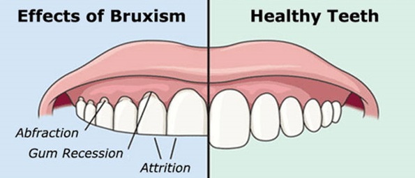 bruxism 