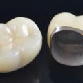 Porcelain Fused to Metal (PFM)