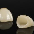 All-Porcelain Crown