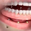 Implant retained dentures